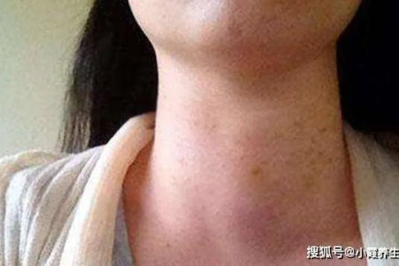 女性甲状腺结节吃鹅蛋的益处与禁忌，中医养生指导