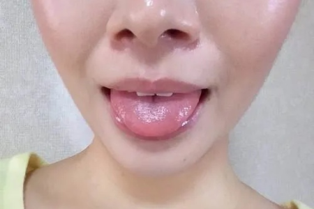 中医养生：齿痕舌彻底根除方法，告别舌头牙齿印