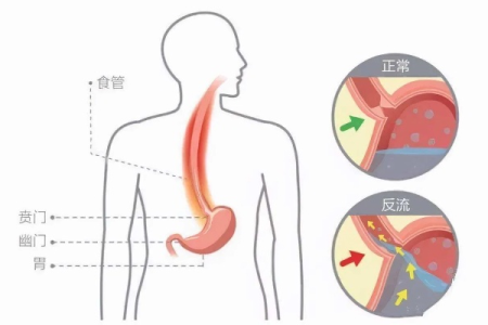 告别反流性食管炎：中医养生调理症状及表现