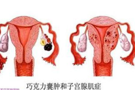 输卵管囊肿的症状和严重程度：中医养生能缓解吗？