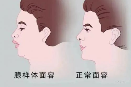 孩子腺样体肥大，中医治疗效果好吗？
