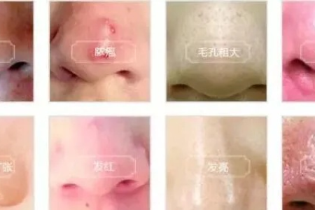 中医养生：玫瑰痤疮是怎么引起的？酒糟鼻的成因与治疗方法