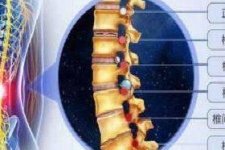 骨质增生腰间盘突出怎么办？中医养生帮你缓解疼痛