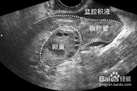 盆腔积液中医怎么治？有效治疗方法及养生建议
