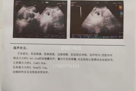孕前检查单核细胞高，是疾病还是正常现象？