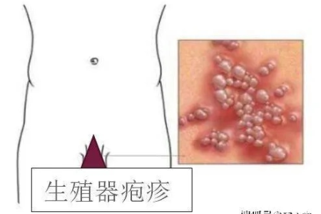 男性生殖器疱疹能治愈吗？备孕期间如何应对疱疹困扰？