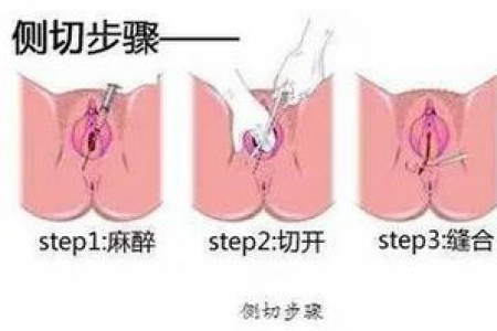 顺产侧切伤口多久才能好？教你快速恢复的护理方法和注意事项