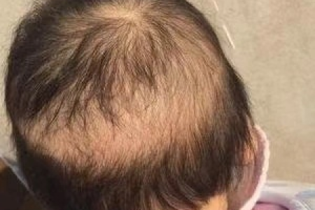 孩子因减肥营养不良脱发，有什么办法？