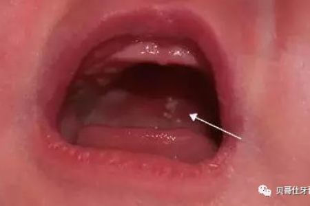 宝宝的马牙会痛吗？马牙对新生儿健康有影响吗？