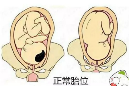 胎位不正是什么原因导致的？详解怀孕期胎位不正的成因