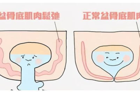 产后骨盆检查：多少周检查？能预测顺产吗？