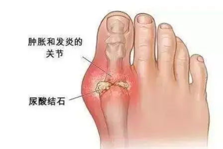 孕前准备：甲亢肝功能不全患者饮食指南