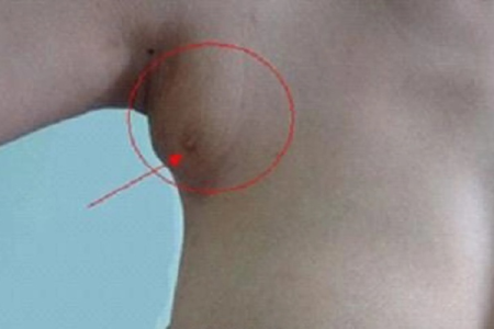 腋下副乳痛，是排卵期问题还是孕前疾病？