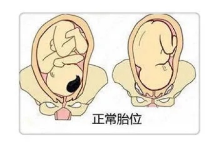 九个月胎位不正怎么办？医生会采取什么治疗方案？
