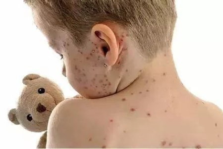 孩子总犯迷糊，学习力下降？警惕少儿ALD肾上腺脑白质营养不良！