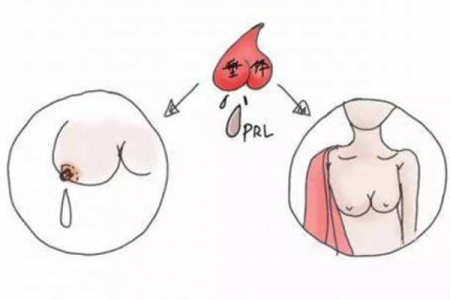 如何诊断产后催乳素瘤？医生常用的几种方法！