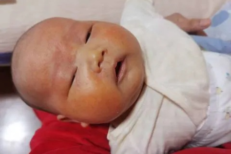 宝宝黄疸是母乳惹的祸？新生儿母乳性黄疸的判断方法