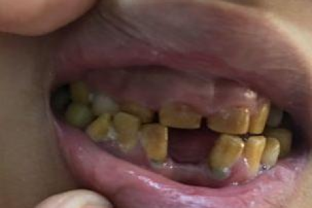 如何识别少儿脑白质营养不良的早期症状？家长应注意什么