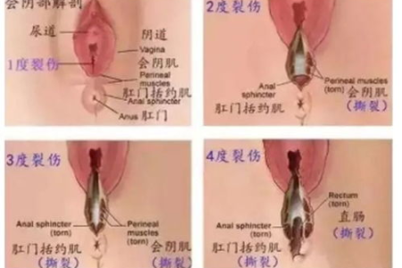 产后护理：顺产侧切是什么意思？新手妈妈必看详解