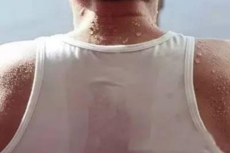夏季老出汗影响生活？教你如何缓解夏季多汗