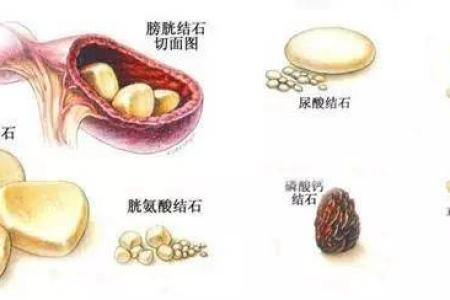 夏季泌尿道结石的成因有哪些？做好预防才能远离结石困扰！
