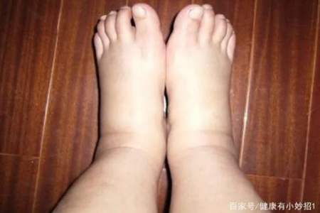 孕期脚肿怎么办？快速消除孕期浮肿的实用指南