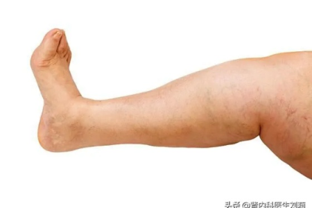小腿总是浮肿怎么办？医生的建议和应对方法