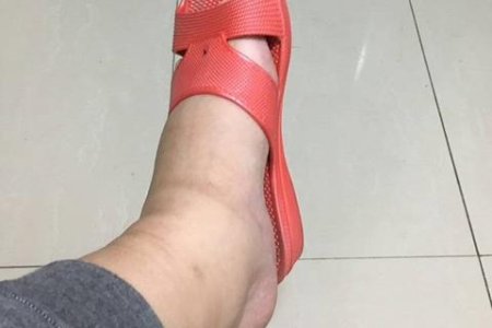 水肿型肥胖如何去水肿 日常小妙招告别浮肿