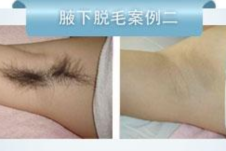 蜜腊脱毛法让你做露露公主轻松拥有光滑肌肤