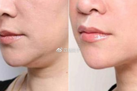 击退双下巴的方法不用手术也能拥有精致下巴