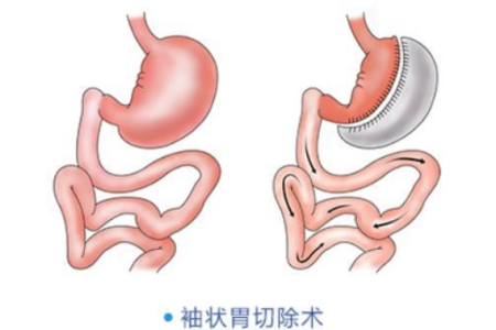 非手术缩胃减肥法大比拼：哪种方式最适合你